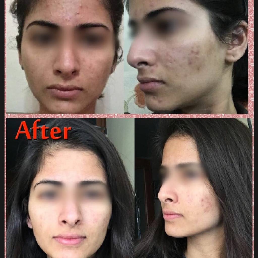 Skin Whitening Treatment in Delhi 